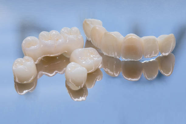 Ceramic Restorations