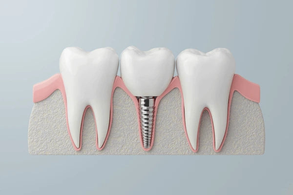 Implant Restorations